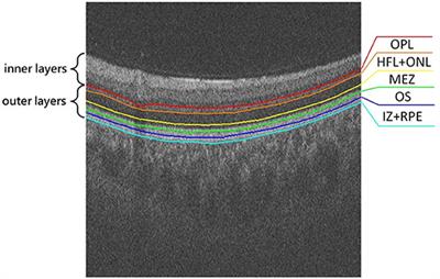 Outer Retinal Layer Thickness Changes in White Matter Hyperintensity and Parkinson's Disease